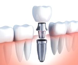 Animated components of dental implant supported replacement tooth