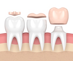 Animated teeth comparing inlay, onlay, and dental crown restorations