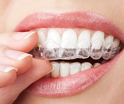 Patient placing a ClearCorrect aligner tray