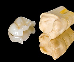 Model tooth with onlay