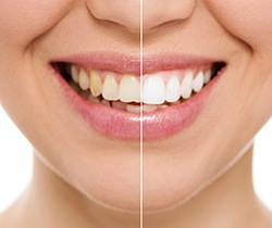 Closeup of smile half before and half after teeth whitening