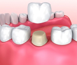 Animated smile during dental crown placement