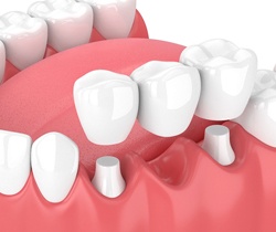 Animated smile during dental crown supported fixed bridge placement