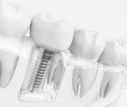 Aninmated dental implant supported dental crown