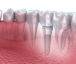 Animated smile with dental implant retained dental crown