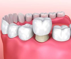 Animated smile during all-ceramic dental crown placement