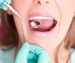 Closeup of patient receiving tooth-colored fillings