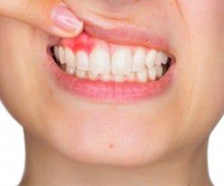Smile with inflamed gums before scaling and root planing