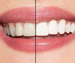 Closeup of smile half before and half after teeth whitening