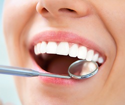 Dentist examining smile after tooth-colored filling restoration