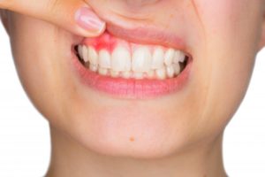 woman exposing pink spot on gums