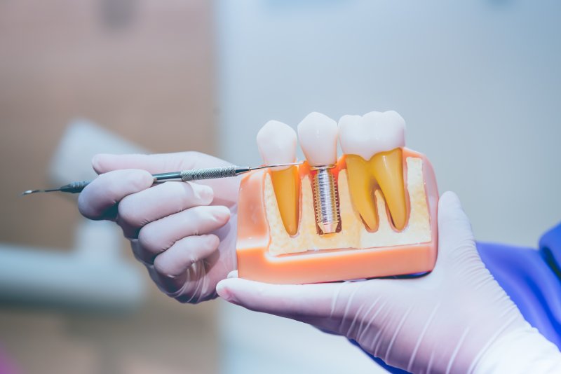 model of a dental implant