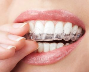 Get a straight smile quickly with ClearCorrect--invisible braces in State College. Discreet, effective correction takes less time and is more comfortable.