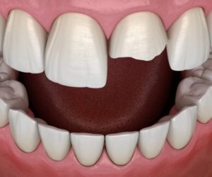 Digital model of chipped front tooth