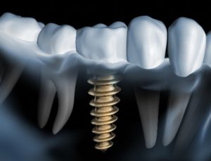 Digital image of a dental implant