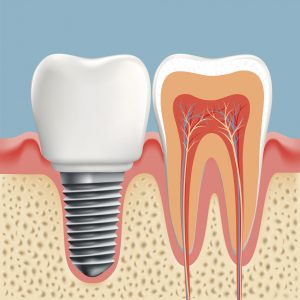 Dental implants in State College create strong smiles. 