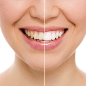 Before and after teeth bleaching or whitening treatment. Close-up of young Caucasian female's smile.