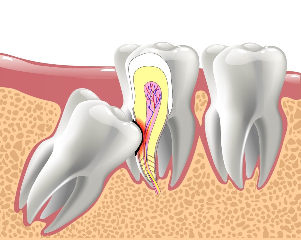 illustration of impacted wisdom tooth