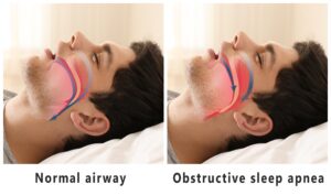 Normal airway compared to obstructive sleep apnea